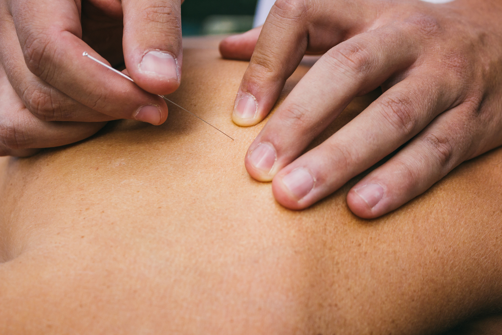 Winston Salem acupuncture provider needling a back with muscle spasm