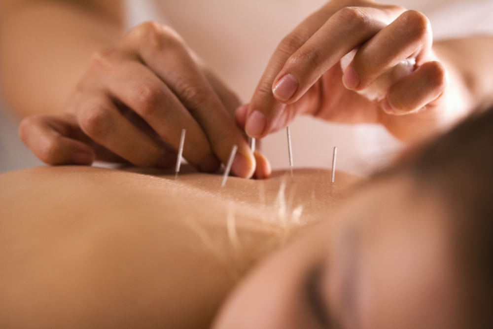 How Acupuncture Works to Relieve Pain